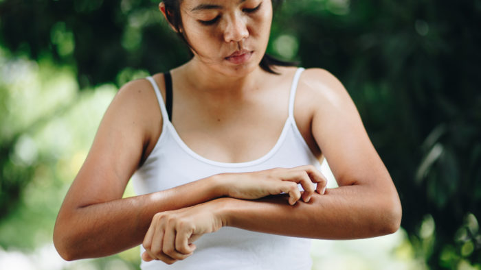 heal eczema diet